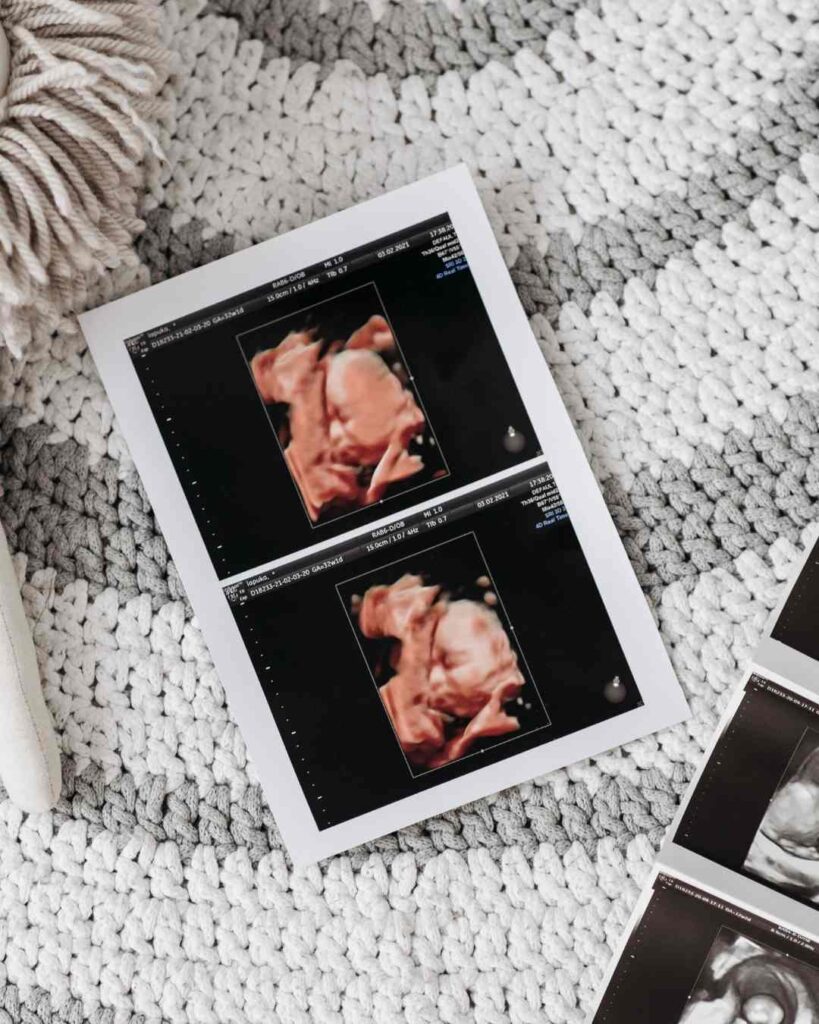 Ultra sound 3D imagery